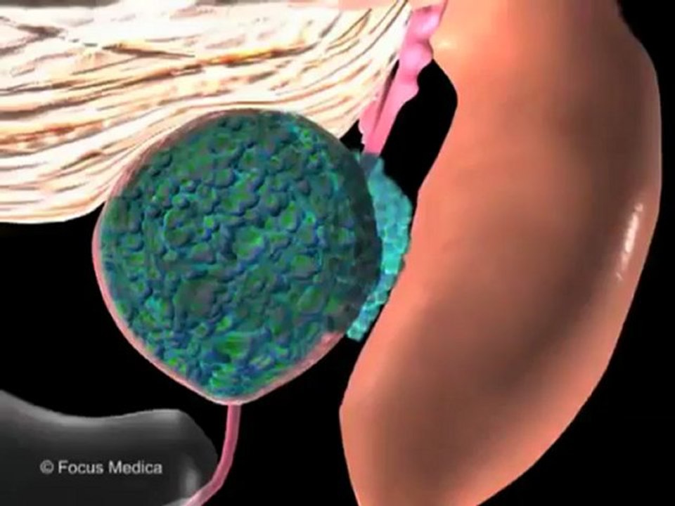 Prostate Cancer (Understanding Disease_ Infectious Diseases & Oncology)