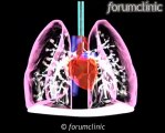 EPOC: la Bronquitis crónica