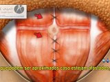 Abdominoplastia - Cirurgia Plástica Porto Alegre - Cirurgião Plástico Dr. André Valiati