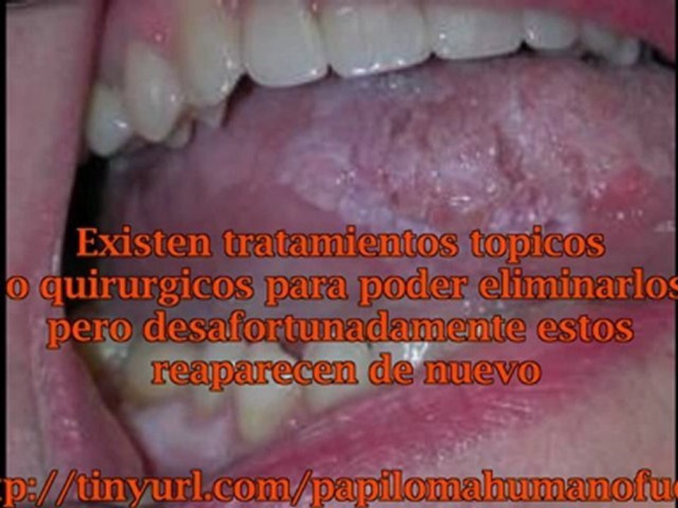 EL CONDILOMA EN LA BOCA