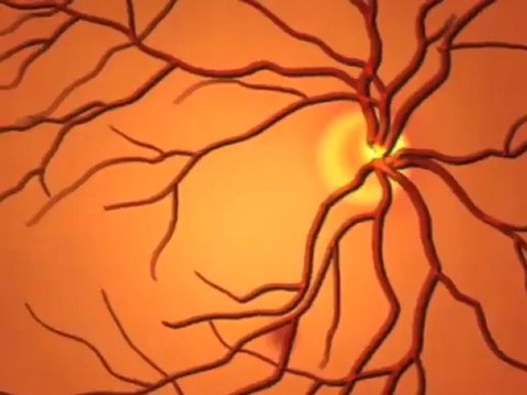 Diabetic Retinopathy (Understanding Disease_ Diabetes & Endocrinology)