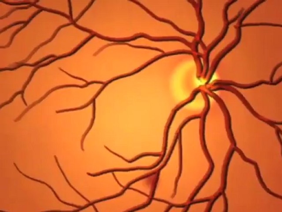 Diabetic Retinopathy (Understanding Disease_ Diabetes & Endocrinology)