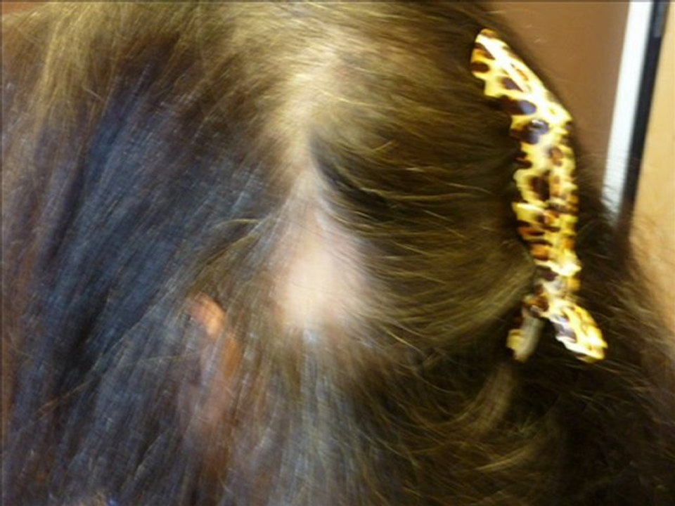 Haarverdichtung