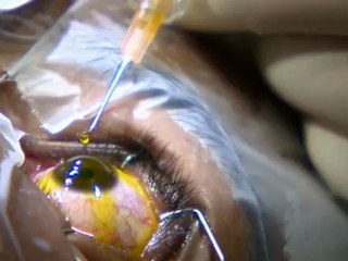 Chirurgie Réfractive à l’Hôpital Percy : Corrigez Myopie, Astigmatisme et Plus sans Hospitalisation 👓