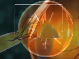 Glaucoma (Understanding Disease_ Ophthalmology)