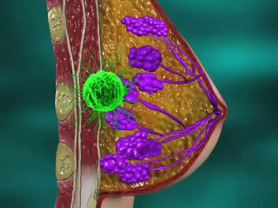 Breast Cancer (Understanding Disease_ Infectious Diseases & Oncology)