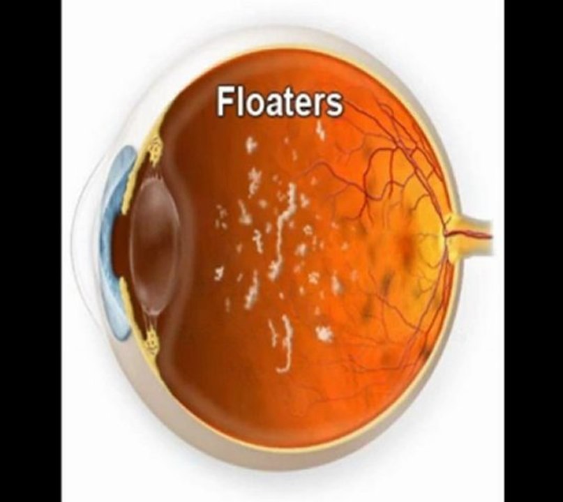 "eye floaters" or "spots in the vision"