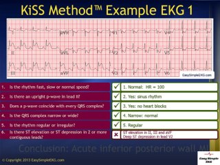 2 Minute EKG Interpretation