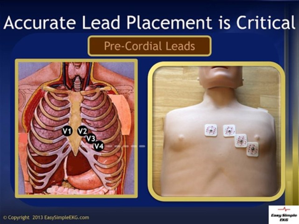 EKG Lead Placement