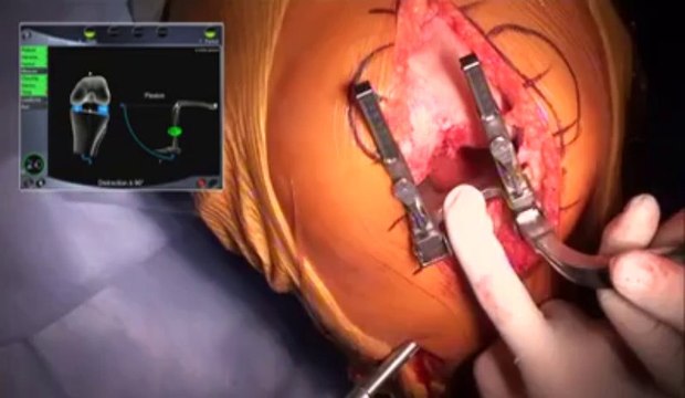 Prothèse du genou assistée par ordinateur