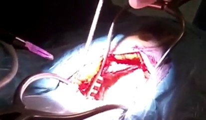 Opération de neurochirurgie au Chr de Namur