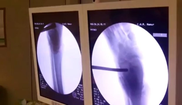 Opération orthopédique sur des pieds plats