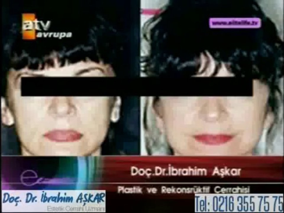 Yüz germe ameliyatı yeterli olmazsa boyunda germe işlemi yapılır mı