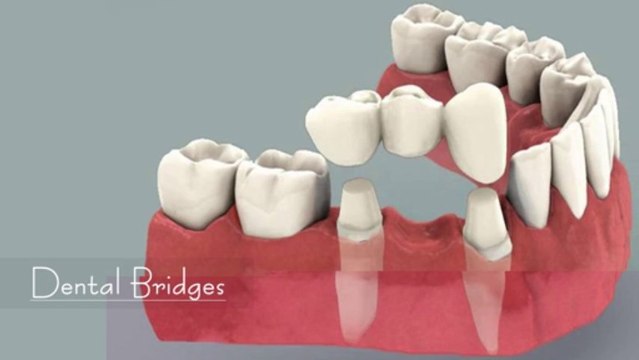 Dental Implant Centre Chennai | Teeth Implants Procedure India