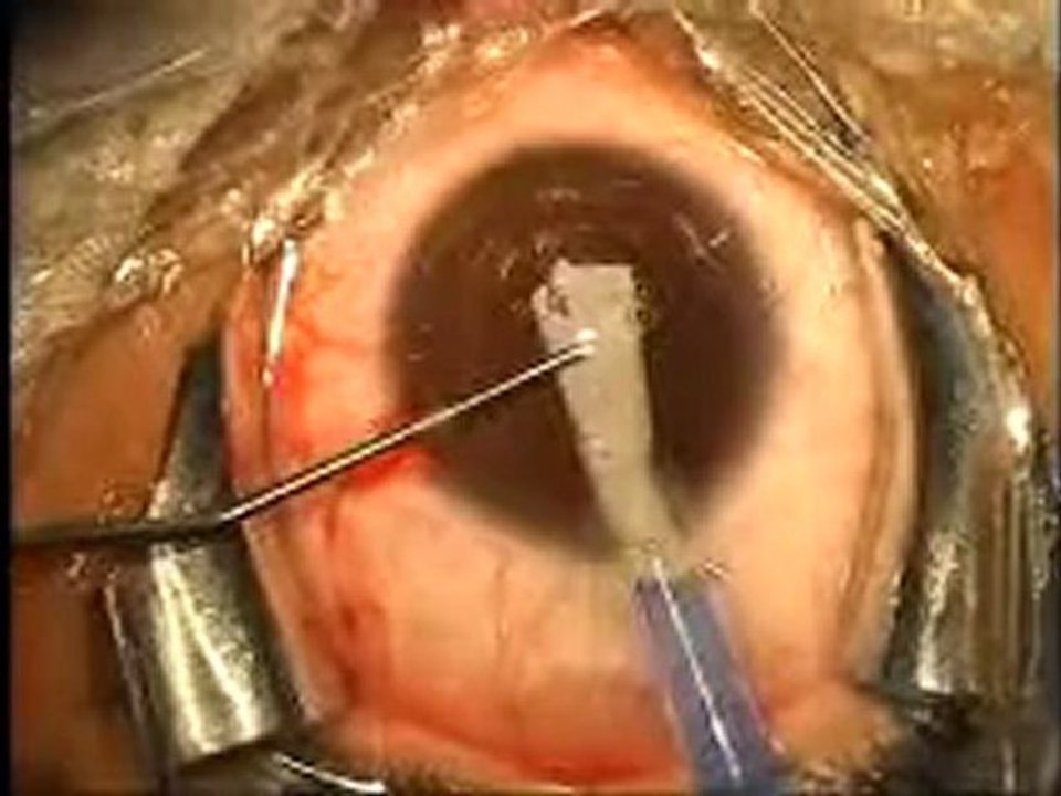 How surgery permanently changes eye color / brightocular