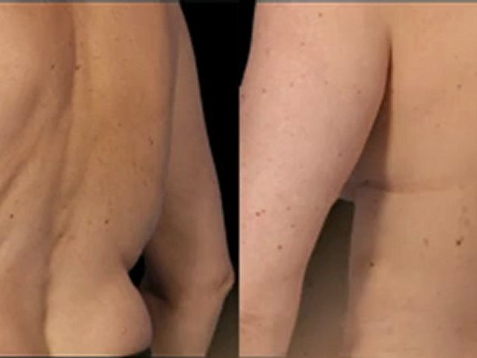 Coolsculpting® Female LoveHandle - 60 Days