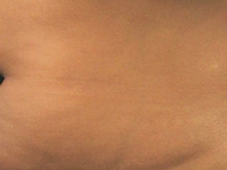 Coolsculpting® Female Abdomen - 60 Days