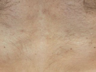 Coolsculpting® Male LoveHandle - 90 Days