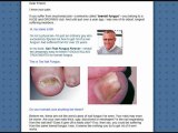 Treatments for toenail fungus