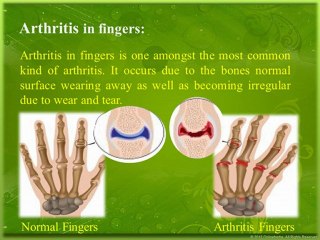 Natural Remedies for Arthritis in Fingers