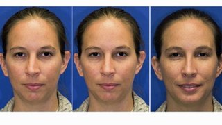 Before & After Seattle Rhinoplasty (Nose job) | Crooked Nose and Chin Augmentation