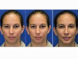 Before & After Seattle Rhinoplasty (Nose job) | Crooked Nose and Chin Augmentation