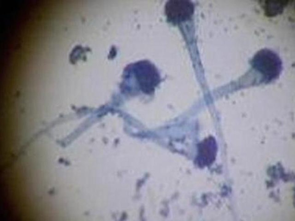 Tainted drugs behind US Meningitis outbreak