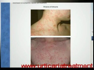 Hives Treatment: The Basics That Work