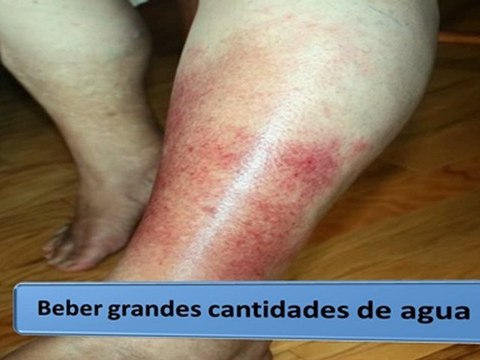 Como Disimular la Celulitis-Reducir Celulitis
