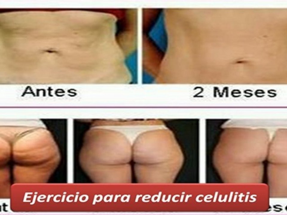Tratamiento Anticelulitis-Consejos Para Eliminar Celulitis
