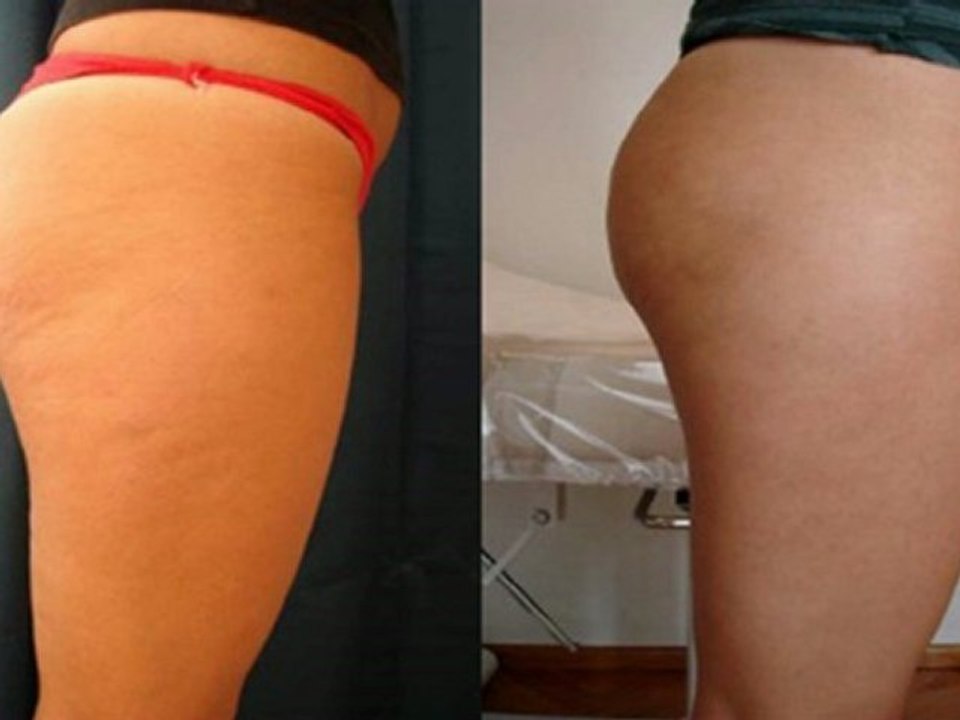 Como Reducir Celulitis en Piernas-Combatir Celulitis Piernas