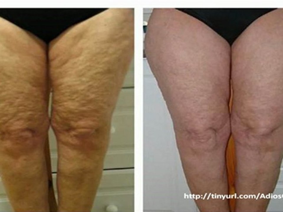 Tratamiento para Eliminar la Celulitis-Como Eliminar la Celulitis