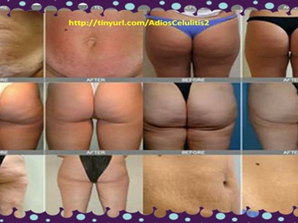 Como Eliminar la Celulitis-Como Desaparecer la Celulitis