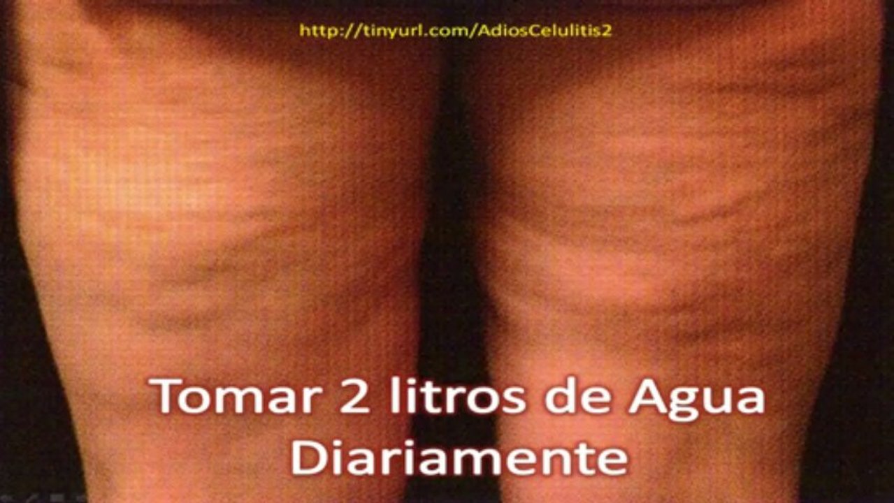 Cómo Combatir la Celulitis-Eliminar Celulitis Gluteos