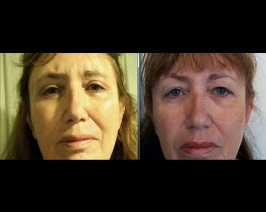 ד"ר אבישי וינברגר - ניתוח אף והרמת עפעפיים