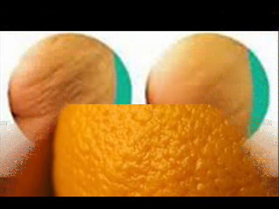 CELULITIS Eliminar la celulitis para siempre "Adios Celulitis"