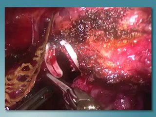 Robotic Prostatectomy