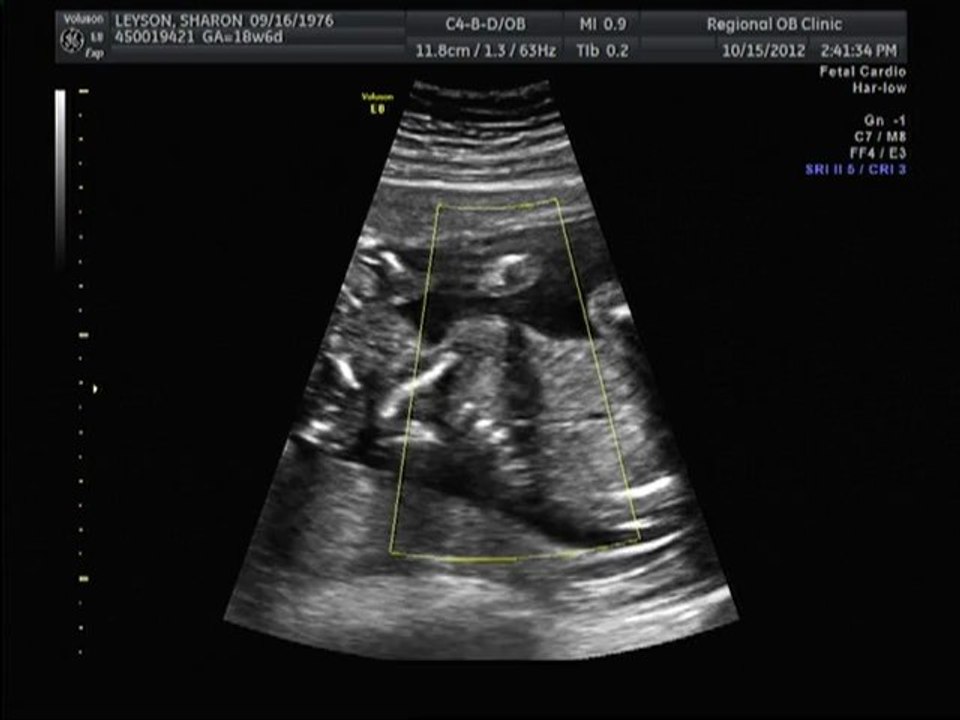 Arya at 18wks6days