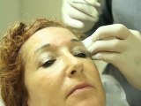 Injection de Botox pour supprimer les rides