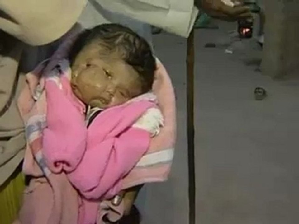 Un enfant né avec 2 visages et 4 oeils