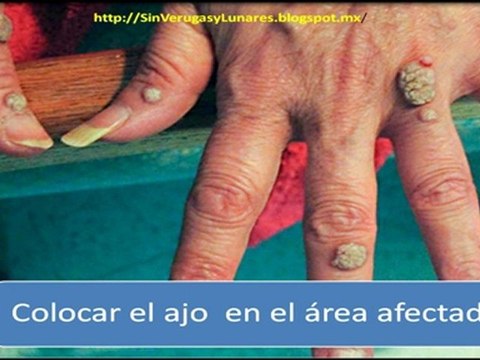 Como Eliminar Las Verrugas y Lunares de Manera Natural y Definitiva
