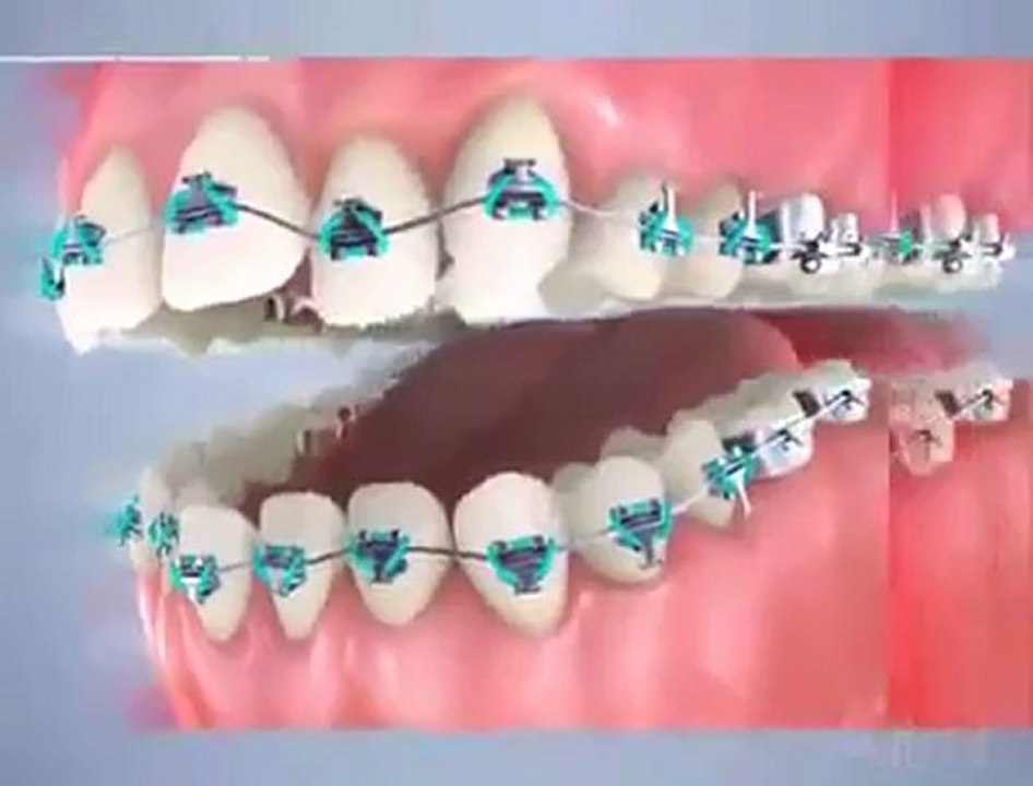 Traitement Multi Attaches