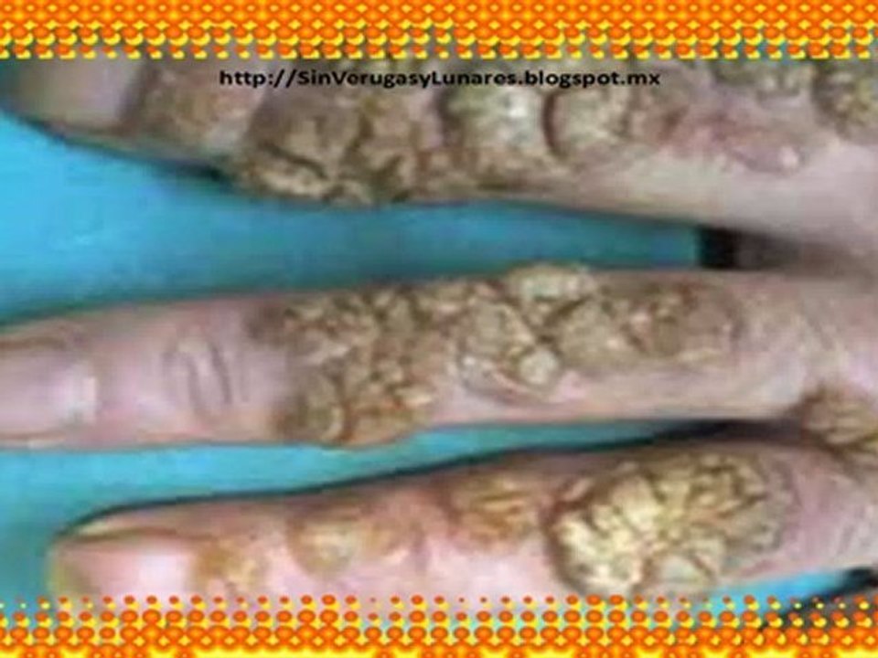 Como Quitar Verrugas-Como Eliminar las berrugas