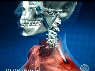 CBS News on Malala Yousafzai recovering, and path of bullet