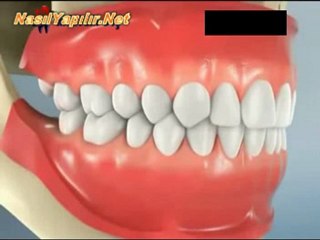 20'lik Diş Çekimi Nasıl Yapılır? | NasılYapılır.Net |