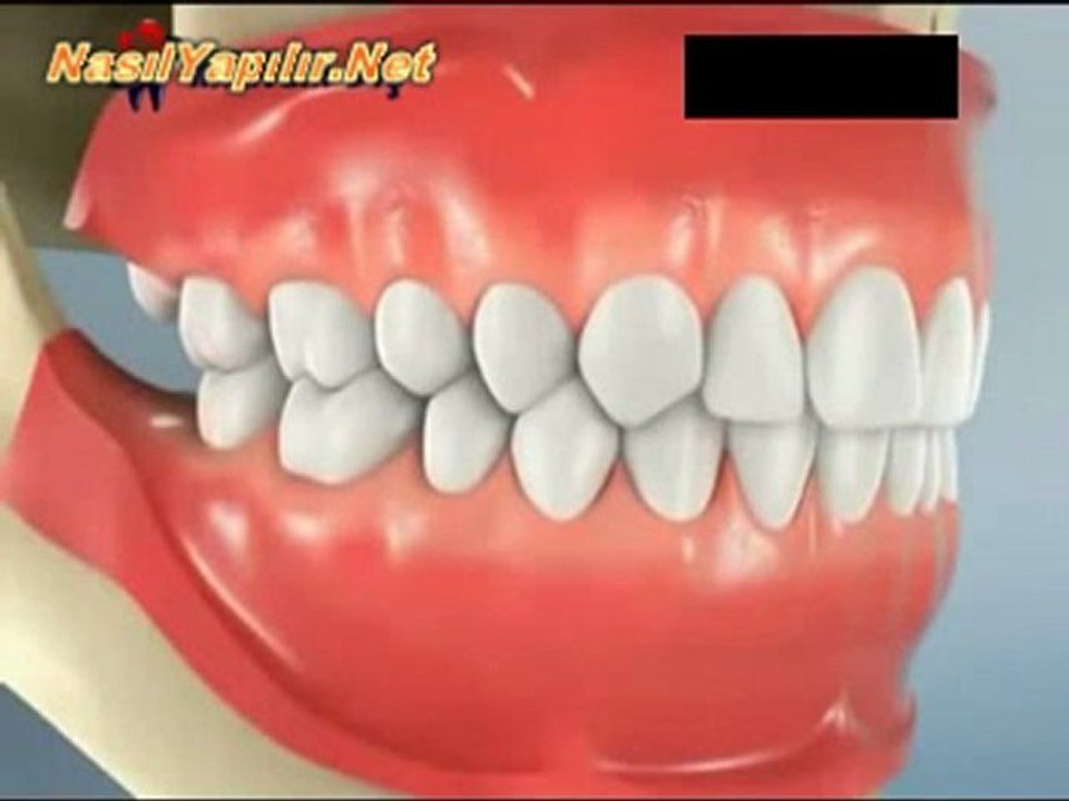 20'lik Diş Çekimi Nasıl Yapılır? | NasılYapılır.Net |