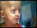 Luchando contra la progeria: Zach Pickard