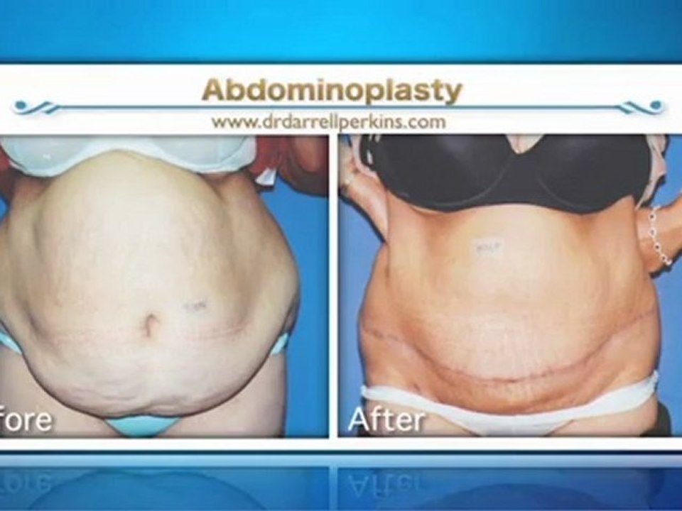 Abdominoplasty Sydney & New South Wales - Dr. Darrell Perkins
