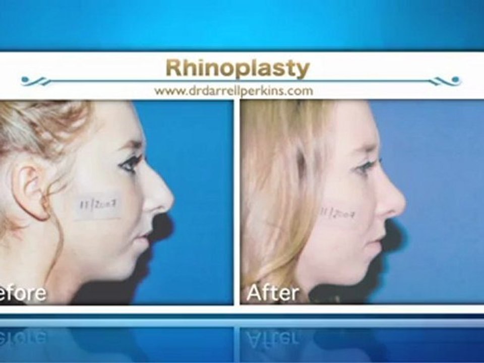 Rhinoplasty Sydney and New South Wales – Dr. Darrell Perkins