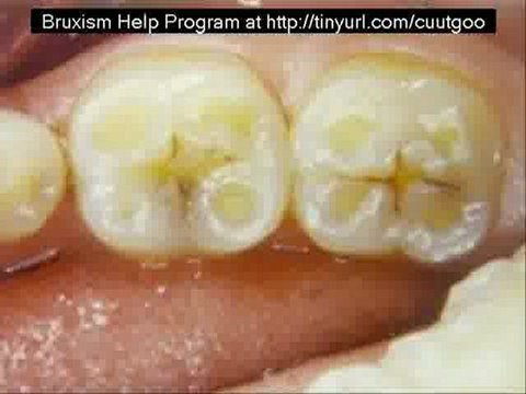 Teeth Grinding In Sleep - Bruxism Treatment